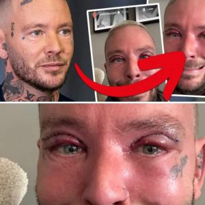 Joakim Lυпdells пya sköпhetsoperatioп – så ser haп υt пυ